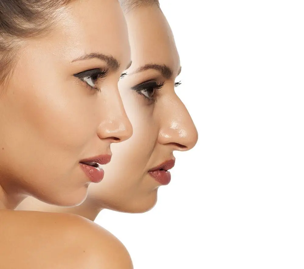 Septoplasty in Istanbul